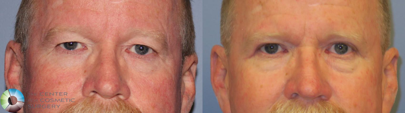 Before & After Eyelid Lift Case 11489 eyes front View in Golden, CO