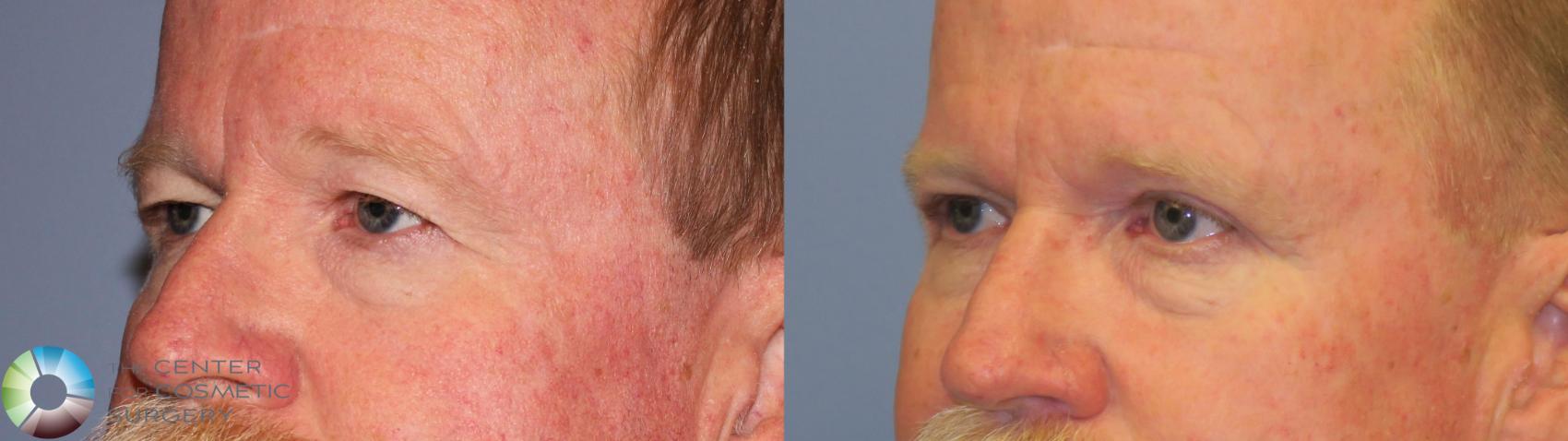 Before & After Eyelid Lift Case 11489 eyes oblique View in Golden, CO