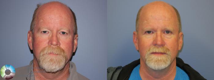 Before & After Eyelid Lift Case 11489 Front View in Golden, CO