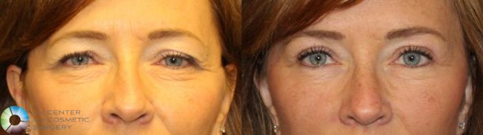Before & After Eyelid Lift Case 11500 brow eyes front View in Golden, CO