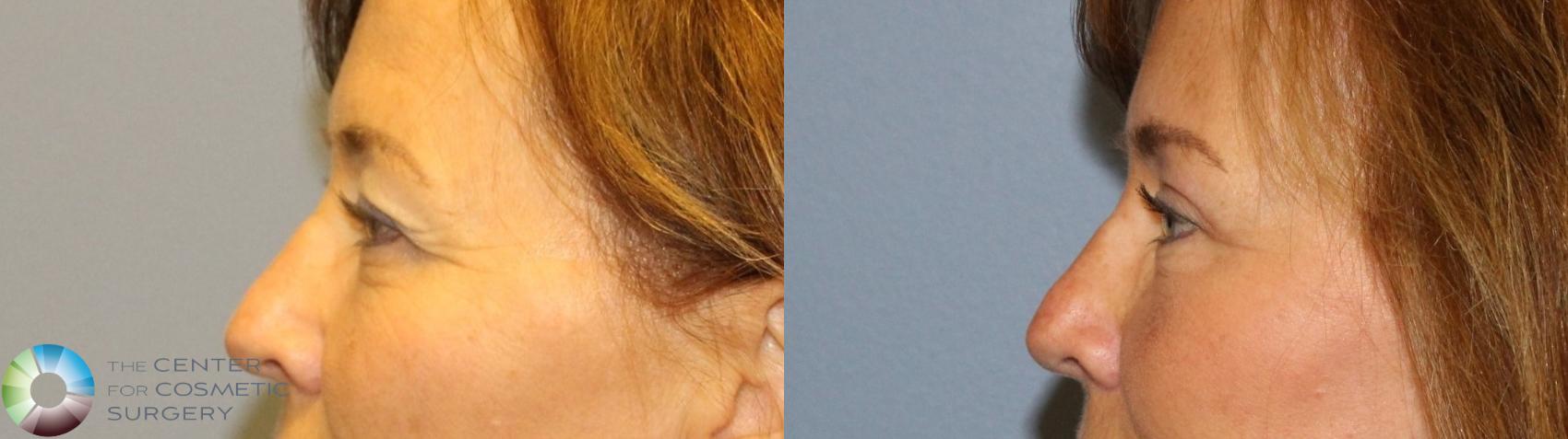Before & After Eyelid Lift Case 11500 brow eyes lateral View in Golden, CO