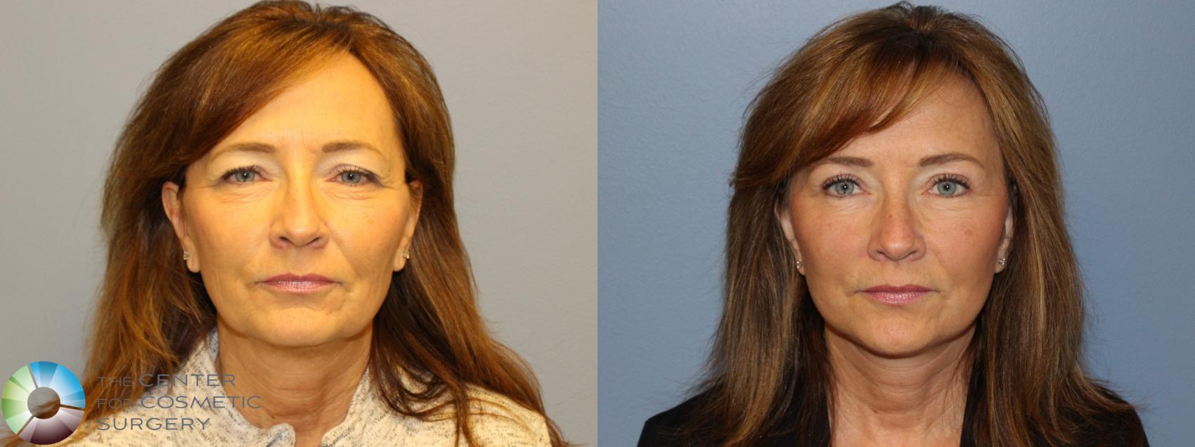 Before & After Eyelid Lift Case 11500 Front View in Golden, CO