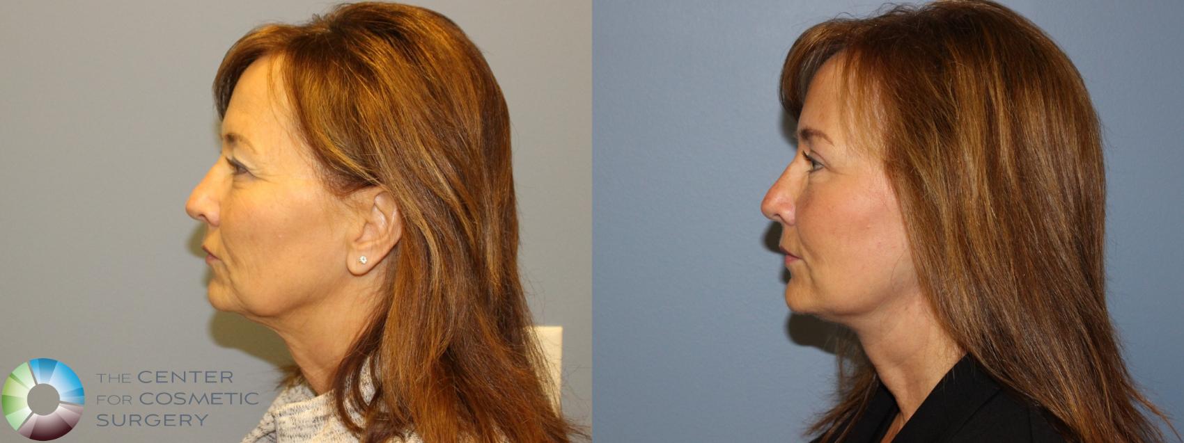 Before & After Eyelid Lift Case 11500 Left Side View in Golden, CO