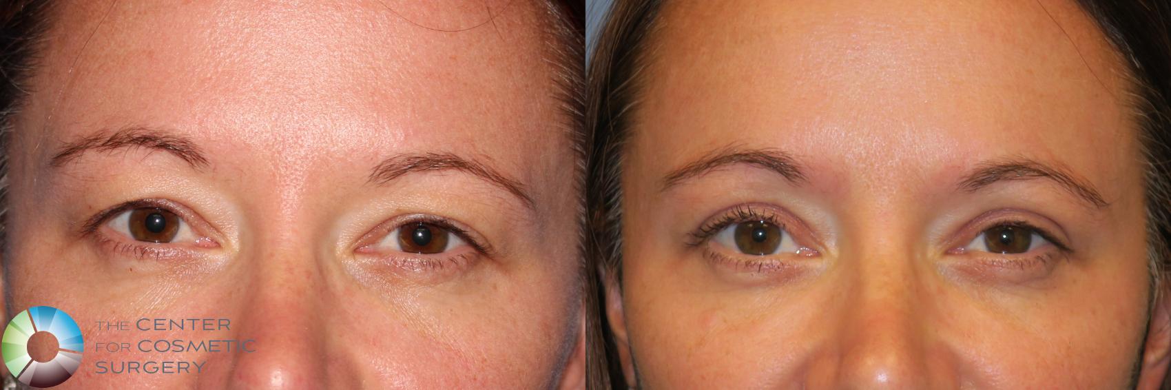 Before & After Eyelid Lift Case 11733 Close-Up View in Golden, CO