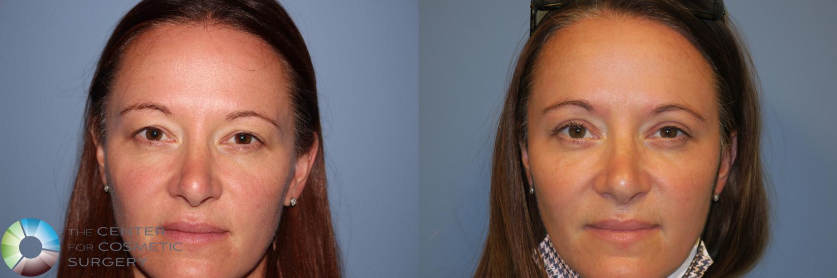 Before & After Eyelid Lift Case 11733 Front View in Golden, CO