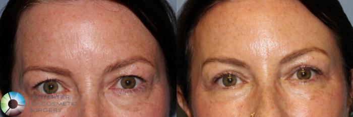 Before & After Eyelid Lift Case 11889 Front View in Golden, CO