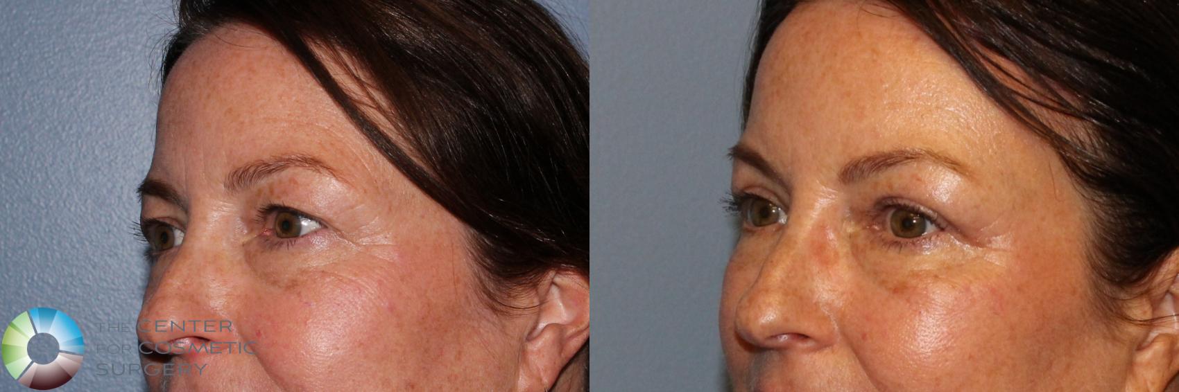 Before & After Eyelid Lift Case 11889 Left Oblique in Denver and Colorado Springs, CO