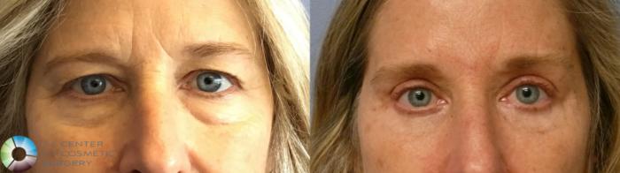 Before & After Eyelid Lift Case 11918 Front View in Golden, CO