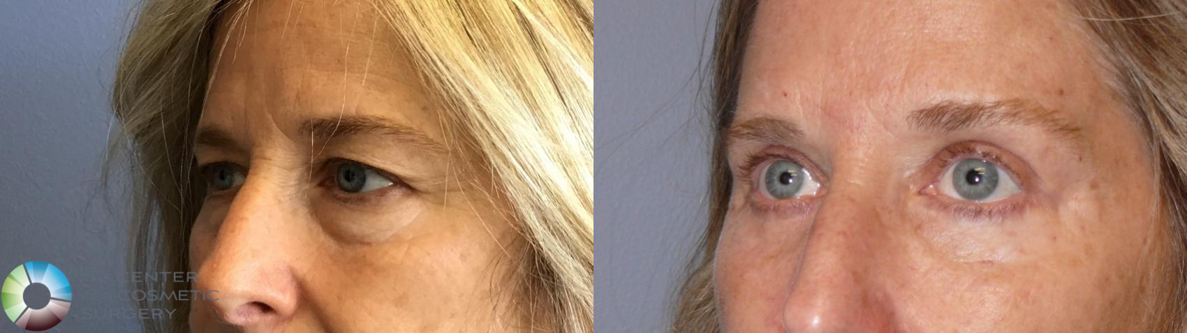 Before & After Eyelid Lift Case 11918 Left Oblique View in Golden, CO