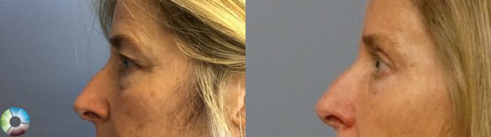 Before & After Eyelid Lift Case 11918 Left Side View in Golden, CO