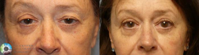 Before & After Eyelid Lift Case 11949 Front in Denver and Colorado Springs, CO