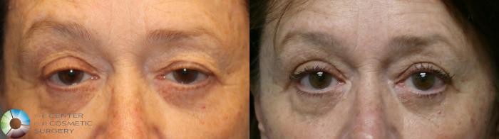 Before & After Eyelid Lift Case 11949 Frontal Close Up in Denver and Colorado Springs, CO