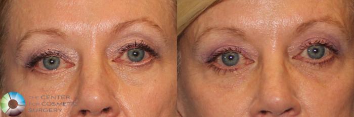 Before & After Eyelid Lift Case 11955 Front in Denver and Colorado Springs, CO