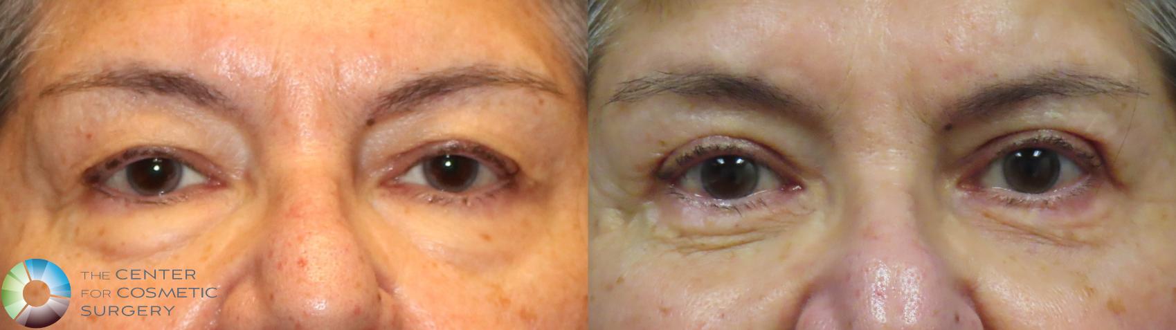 Before & After Eyelid Lift Case 11976 Front in Denver and Colorado Springs, CO