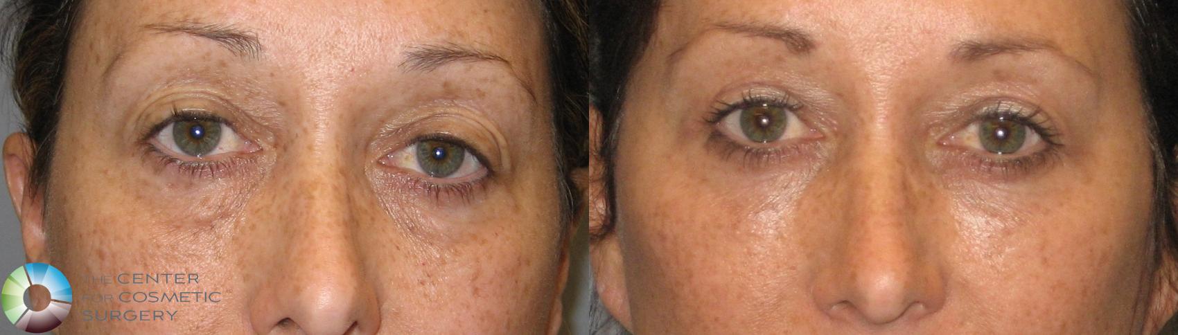 Before & After Eyelid Lift Case 161 View #1 in Denver, CO