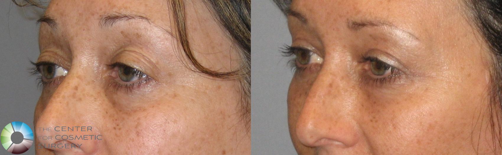 Before & After Eyelid Lift Case 161 View #2 in Denver and Colorado Springs, CO