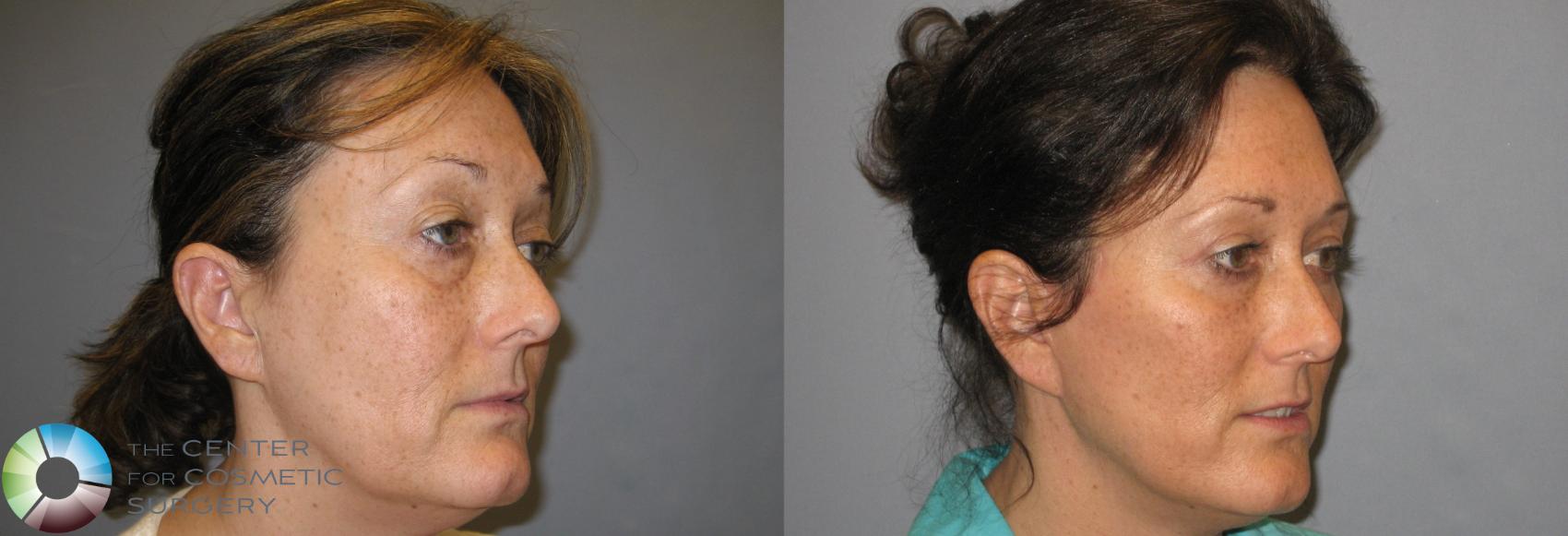 Before & After Eyelid Lift Case 161 View #4 in Denver and Colorado Springs, CO