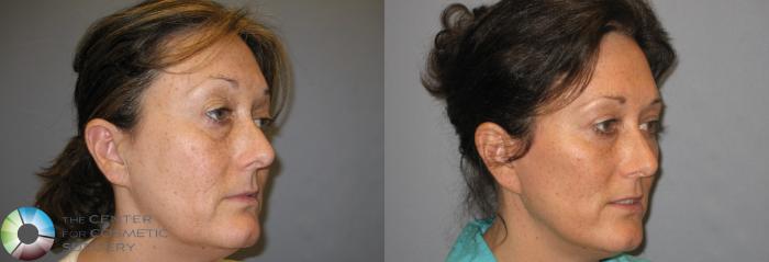 Before & After Eyelid Lift Case 161 View #4 in Denver, CO