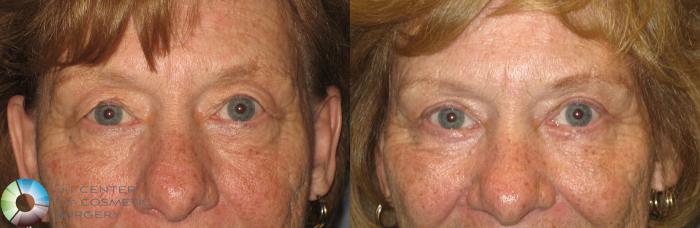 Before & After Eyelid Lift Case 209 View #1 in Denver, CO