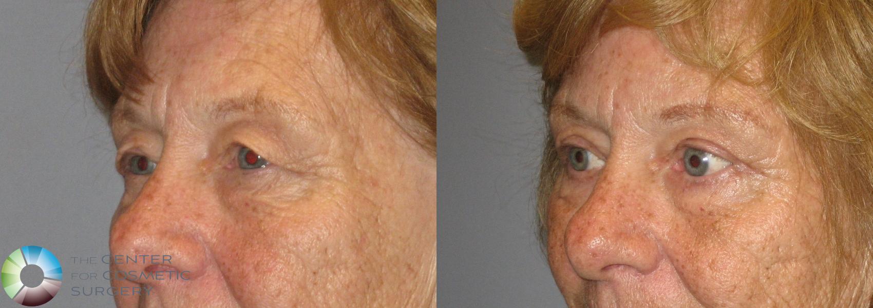 Before & After Eyelid Lift Case 209 View #2 View in Golden, CO