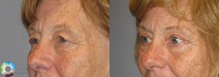Before & After Eyelid Lift Case 209 View #2 in Denver, CO