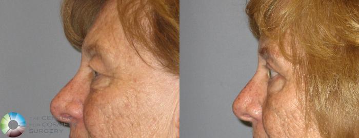 Before & After Eyelid Lift Case 209 View #3 in Denver, CO