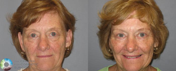 Before & After Eyelid Lift Case 209 View #4 in Denver, CO