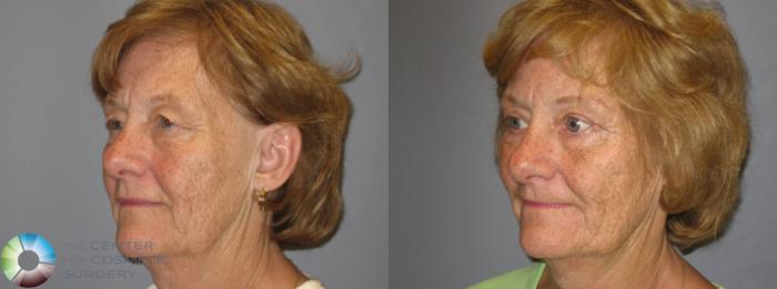 Before & After Eyelid Lift Case 209 View #5 in Denver, CO