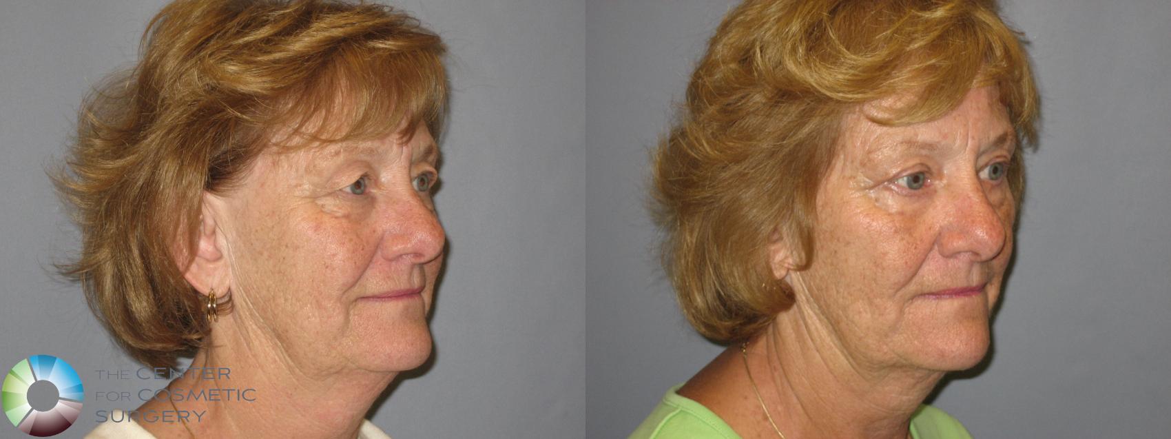 Before & After Eyelid Lift Case 209 View #6 View in Golden, CO