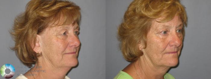 Before & After Eyelid Lift Case 209 View #6 in Denver, CO