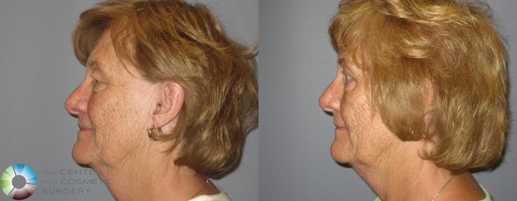 Before & After Eyelid Lift Case 209 View #7 View in Golden, CO