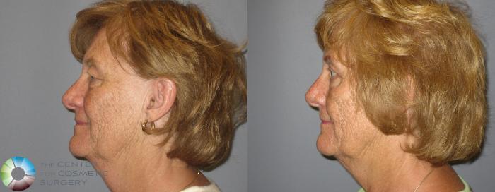 Before & After Eyelid Lift Case 209 View #7 in Denver, CO