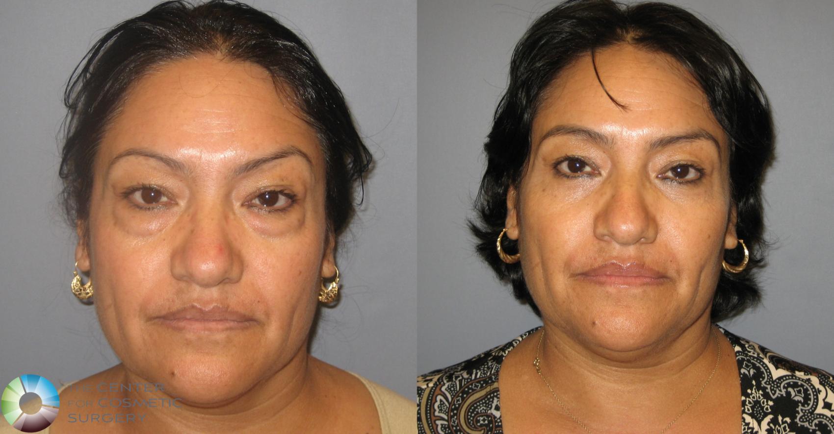 Before & After Eyelid Lift Case 233 View #1 View in Golden, CO