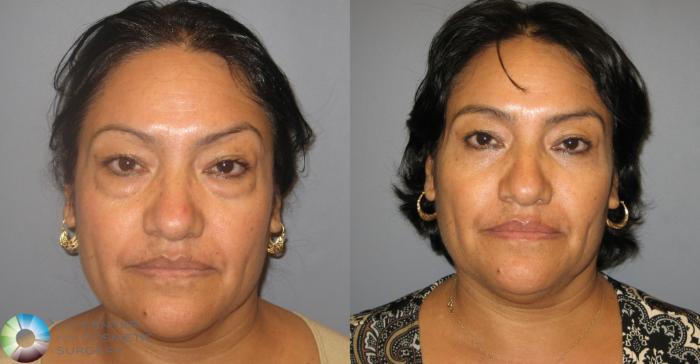 Before & After Eyelid Lift Case 233 View #1 in Denver and Colorado Springs, CO