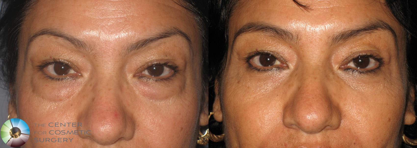 Before & After Eyelid Lift Case 233 View #2 View in Golden, CO