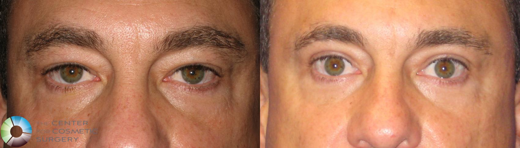 Before & After Eyelid Lift Case 237 View #1 in Denver and Colorado Springs, CO