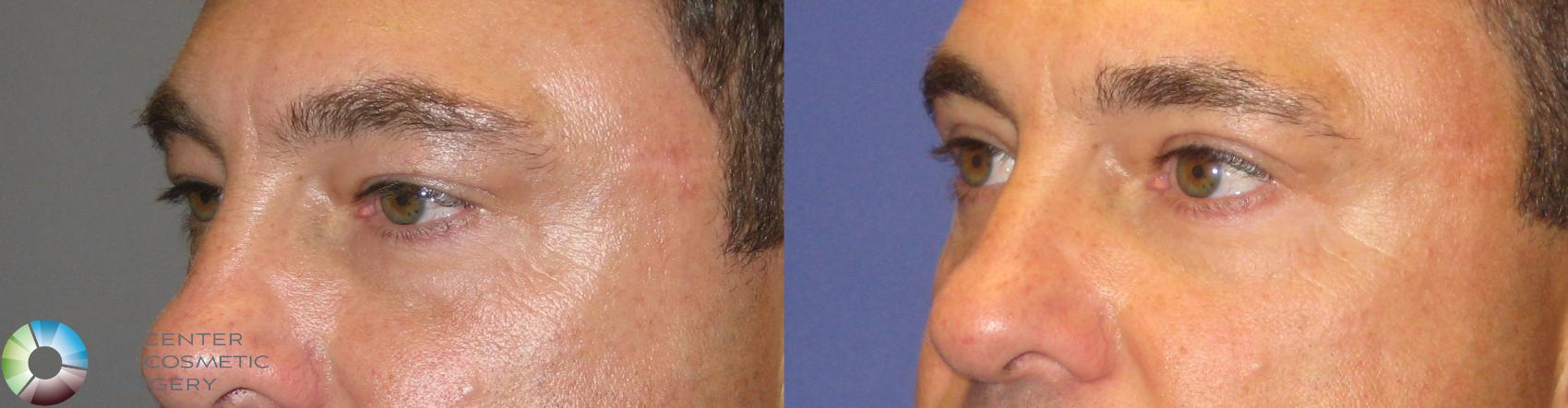 Before & After Eyelid Lift Case 237 View #2 View in Golden, CO
