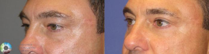 Before & After Eyelid Lift Case 237 View #2 in Denver and Colorado Springs, CO