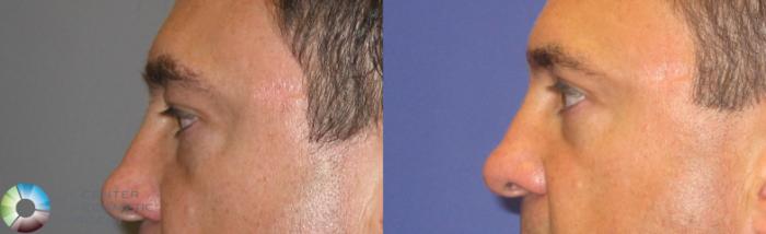 Before & After Eyelid Lift Case 237 View #3 in Denver and Colorado Springs, CO