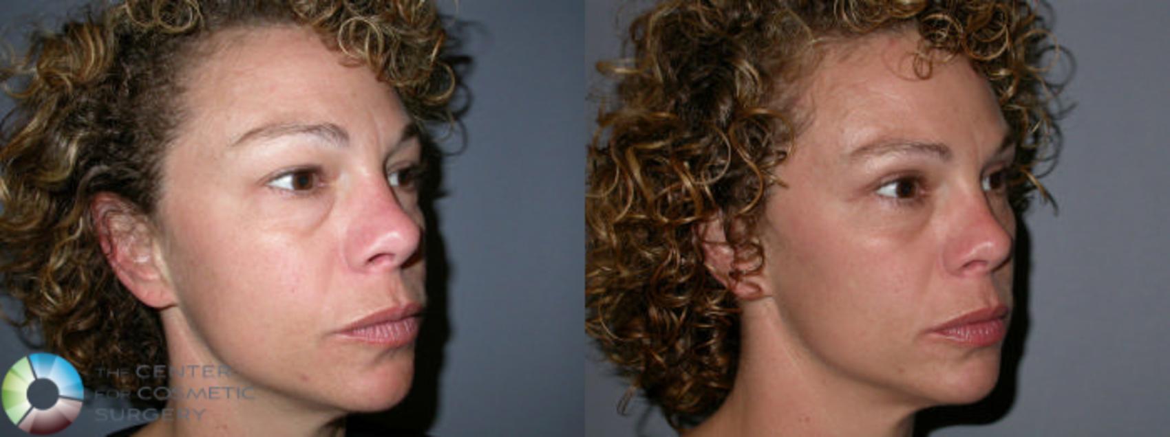 Before & After Eyelid Lift Case 24 View #1 View in Golden, CO