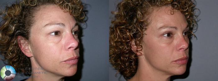Before & After Eyelid Lift Case 24 View #1 in Denver and Colorado Springs, CO