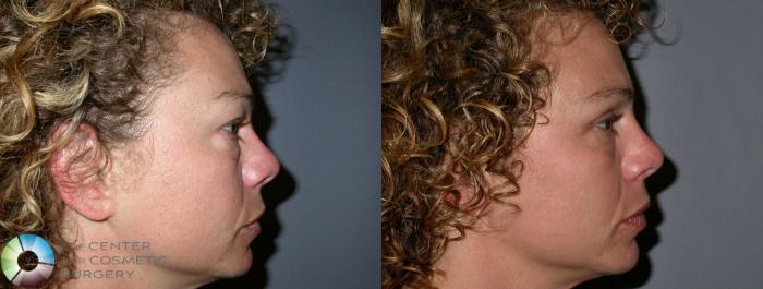 Before & After Eyelid Lift Case 24 View #2 in Denver and Colorado Springs, CO