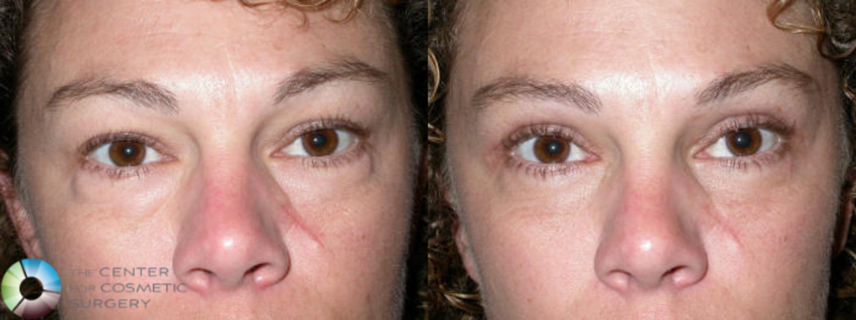 Before & After Eyelid Lift Case 24 View #3 View in Golden, CO