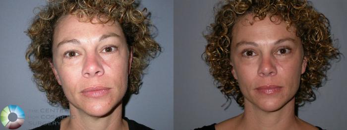 Before & After Eyelid Lift Case 24 View #4 in Denver and Colorado Springs, CO