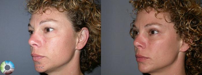 Before & After Eyelid Lift Case 24 View #6 in Denver and Colorado Springs, CO