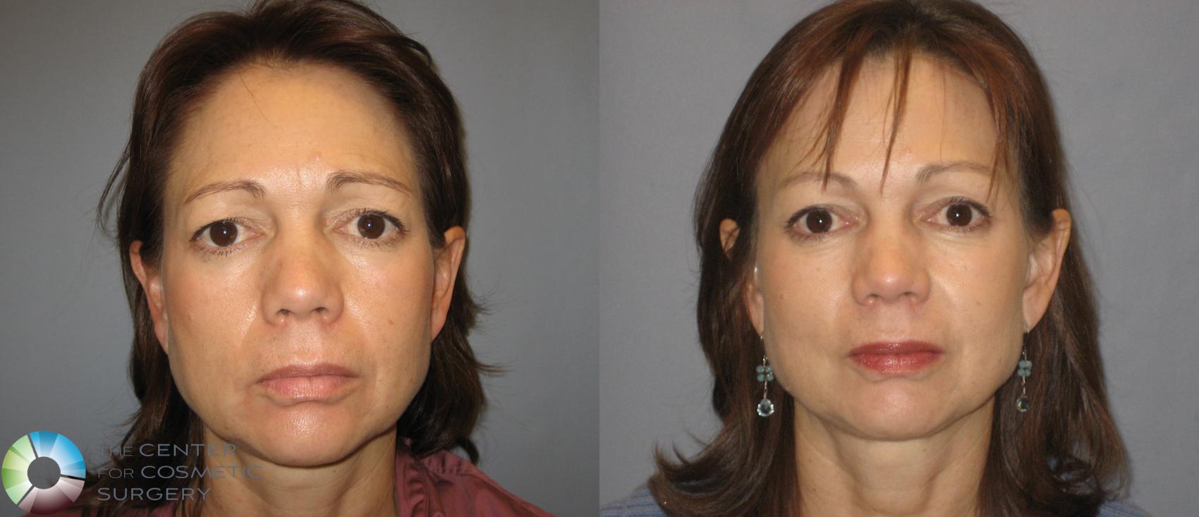 Before & After Eyelid Lift Case 252 View #1 View in Golden, CO