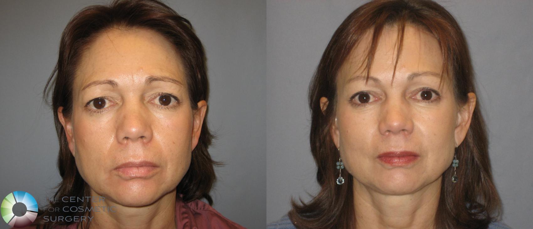 Before & After Eyelid Lift Case 252 View #1 in Denver and Colorado Springs, CO