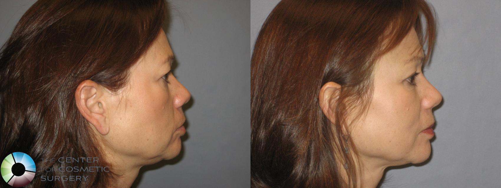 Before & After Eyelid Lift Case 252 View #2 View in Golden, CO