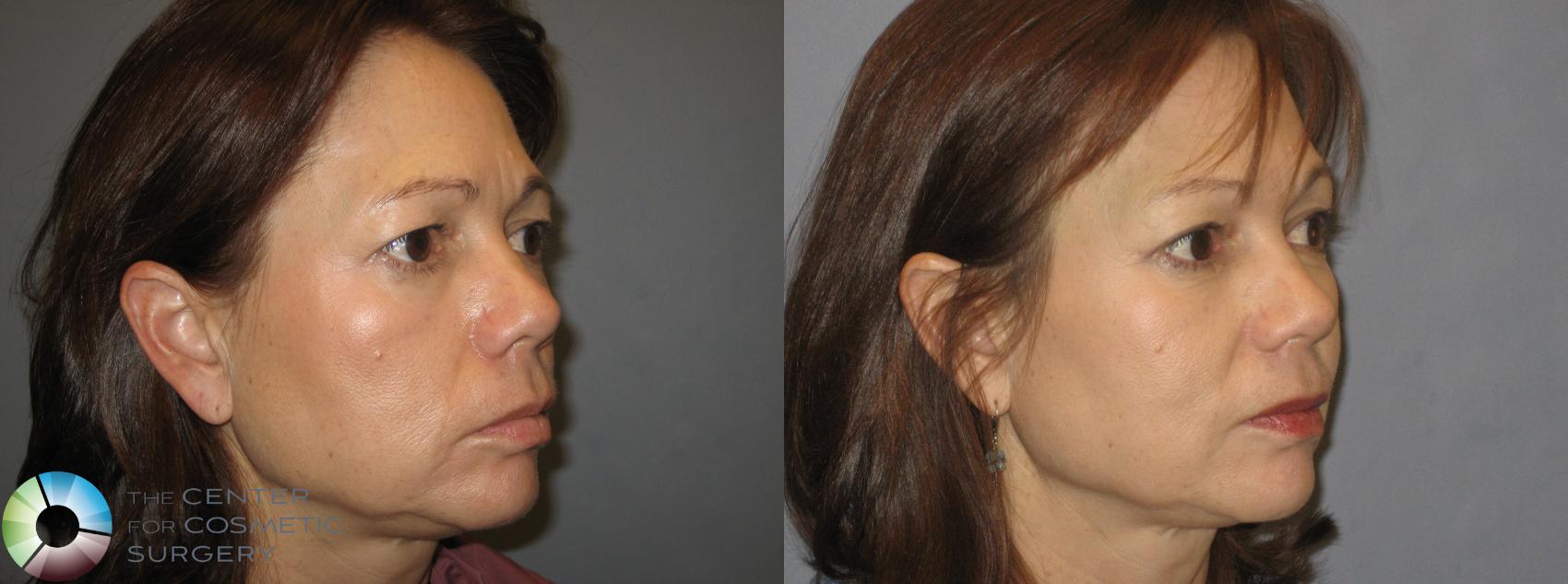 Before & After Eyelid Lift Case 252 View #3 View in Golden, CO
