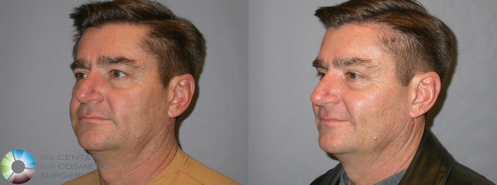Before & After Eyelid Lift Case 257 View #2 in Denver and Colorado Springs, CO